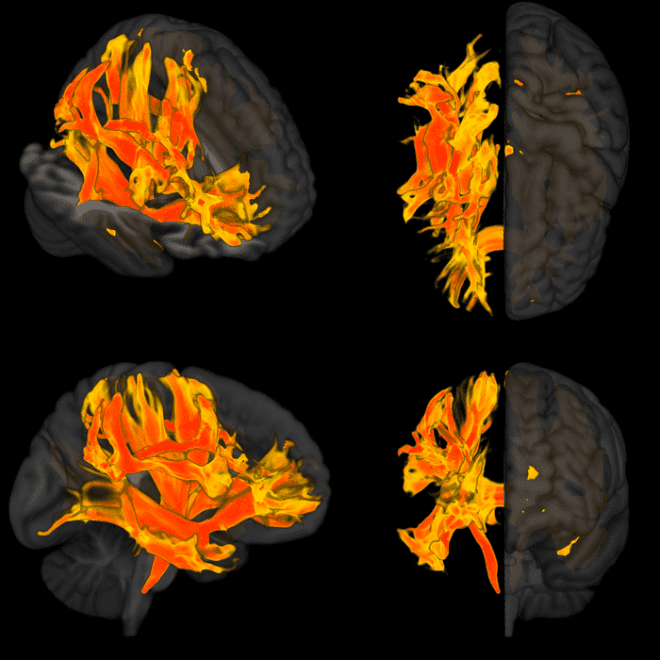 figure - Άνοια: Η υψηλή πίεση συμβάλλει στην ανάπτυξή της