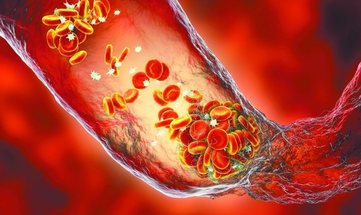 Η ήπια COVID-19 γερνά τις αρτηρίες πιο γρήγορα