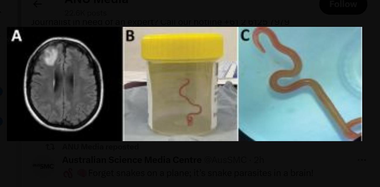 Ενα παγκοσμίως πρωτοφανές ιατρικό γεγονός: Ζωντανό σκουλήκι σε ανθρώπινο εγκέφαλο* Είναι η πρώτη μολυσματική μετάδοση παρασίτου από πύθωνα σε άνθρωπο