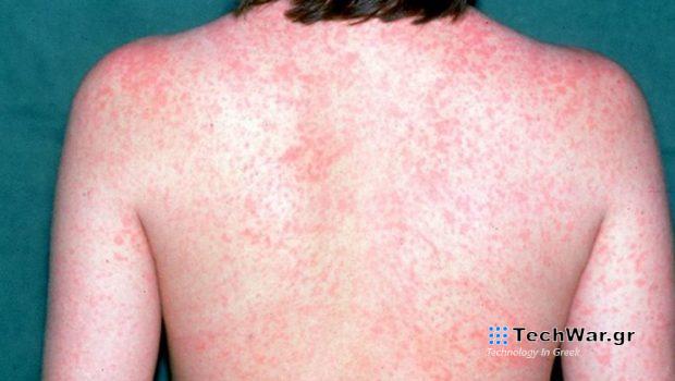 Κρούσματα ιλαράς και εμβόλια στους εργαζόμενους στην υγεία ως τις 22 Μαρτίου