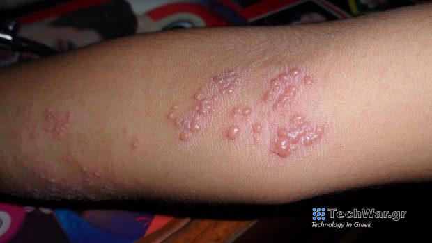 Άγνοια κινδύνου από τον έρπη ζωστήρα στο 86% του πληθυσμού